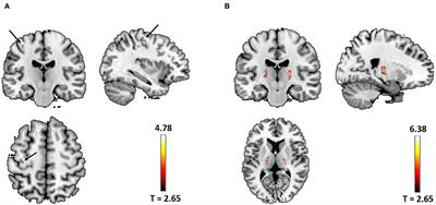 Beyond the Motor Cortex: Thalamic Iron Deposition Accounts for Disease Severity in Amyotrophic Lateral Sclerosis